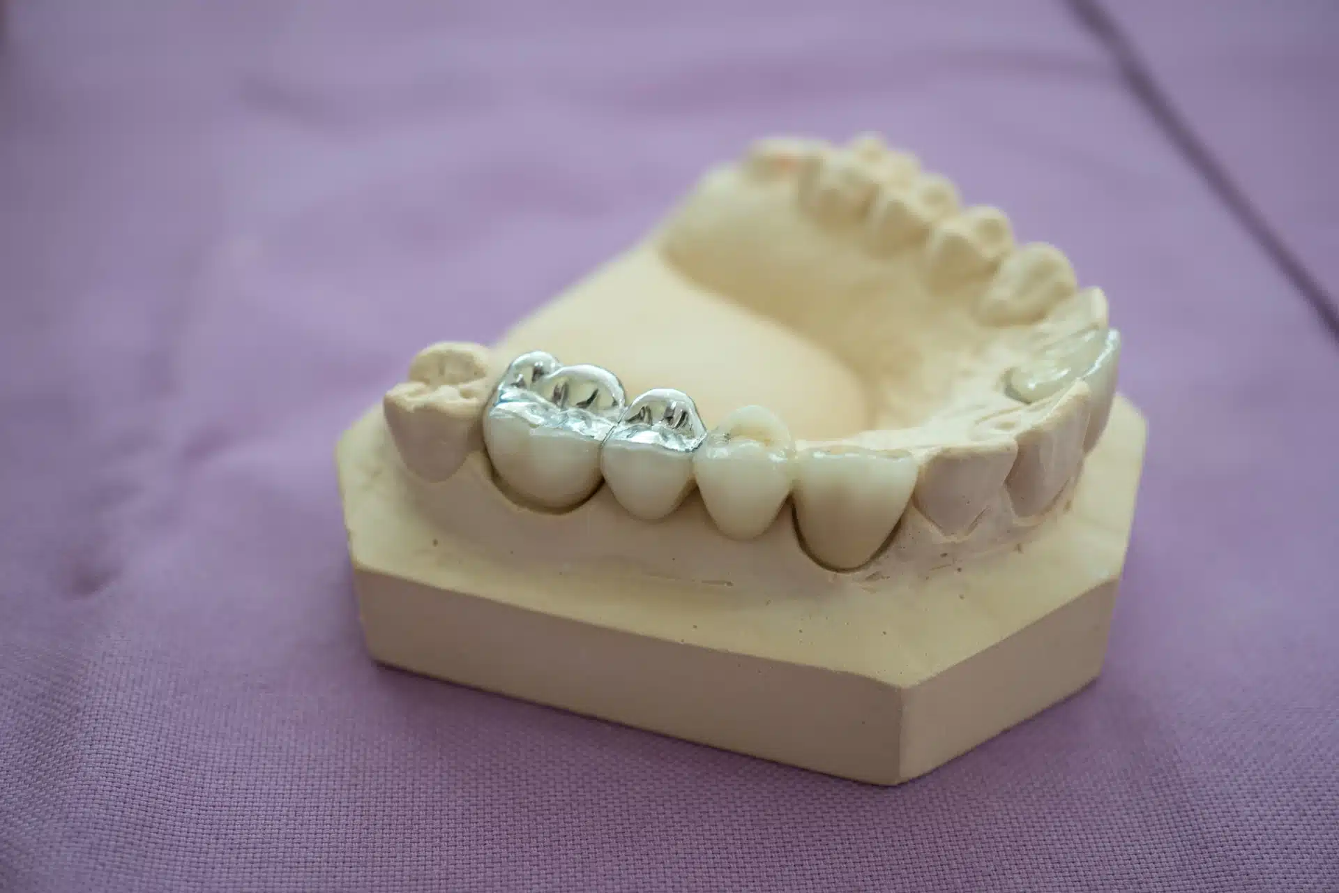 A dental model with amalgam fillings