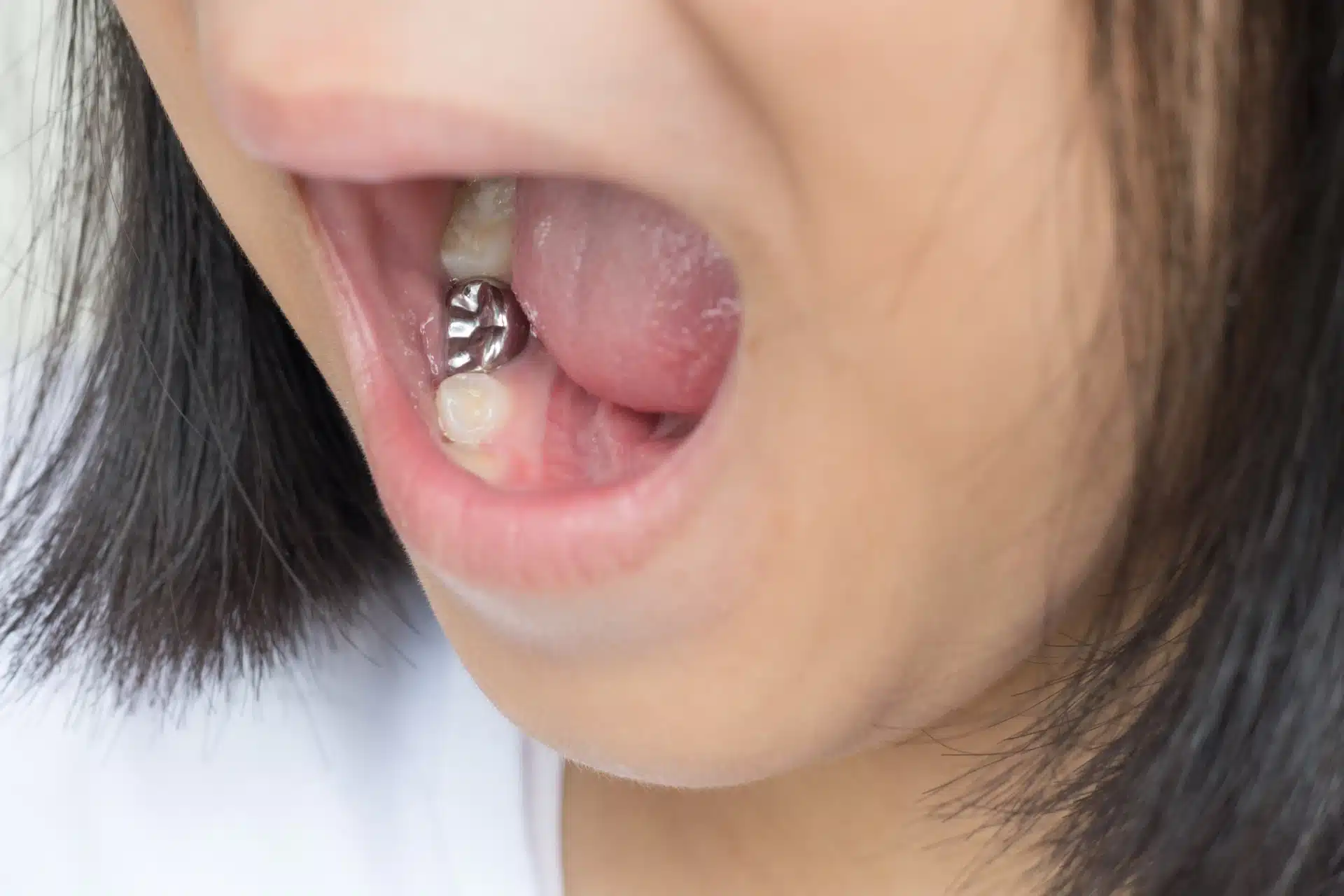 A little girl opening her mouth, revealing an amalgam dental filling